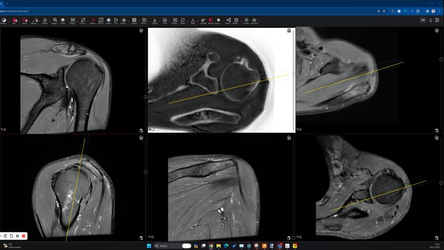 value of bone MRI