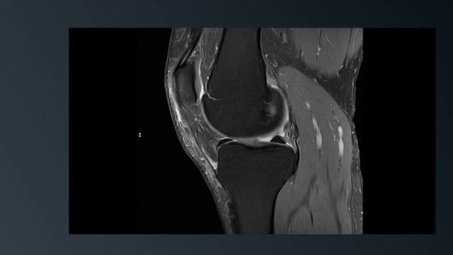 Anatomic Variant: AIMM into ACL