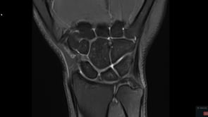 Confirmed TFCC Tear With Postoperative Re-tear