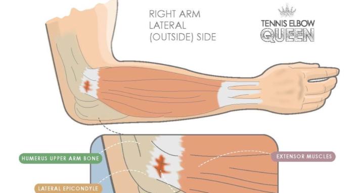 Tennis Elbow Academy