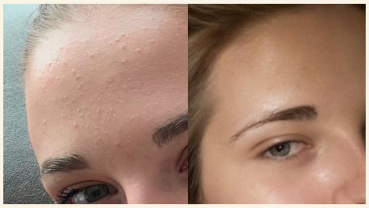 The Clear Skin Situation 