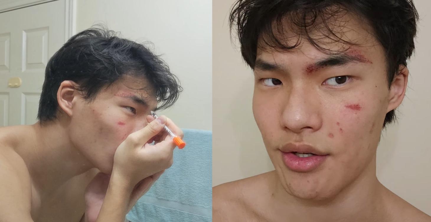 DermaNeedling Routine