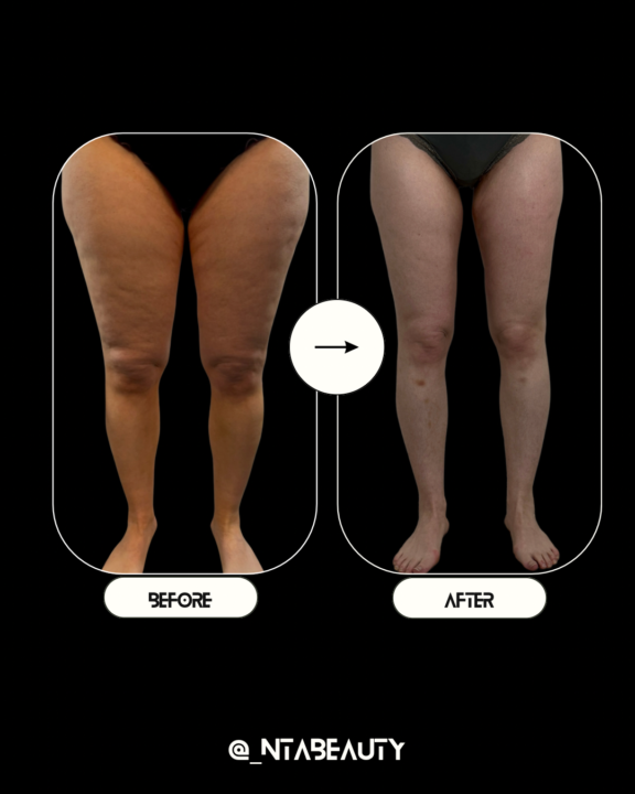 Ultimate leg cellulite case study, why timing and variation matter