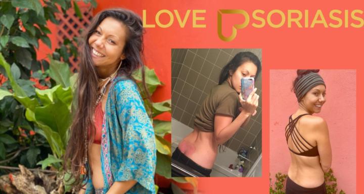Love Psoriasis
