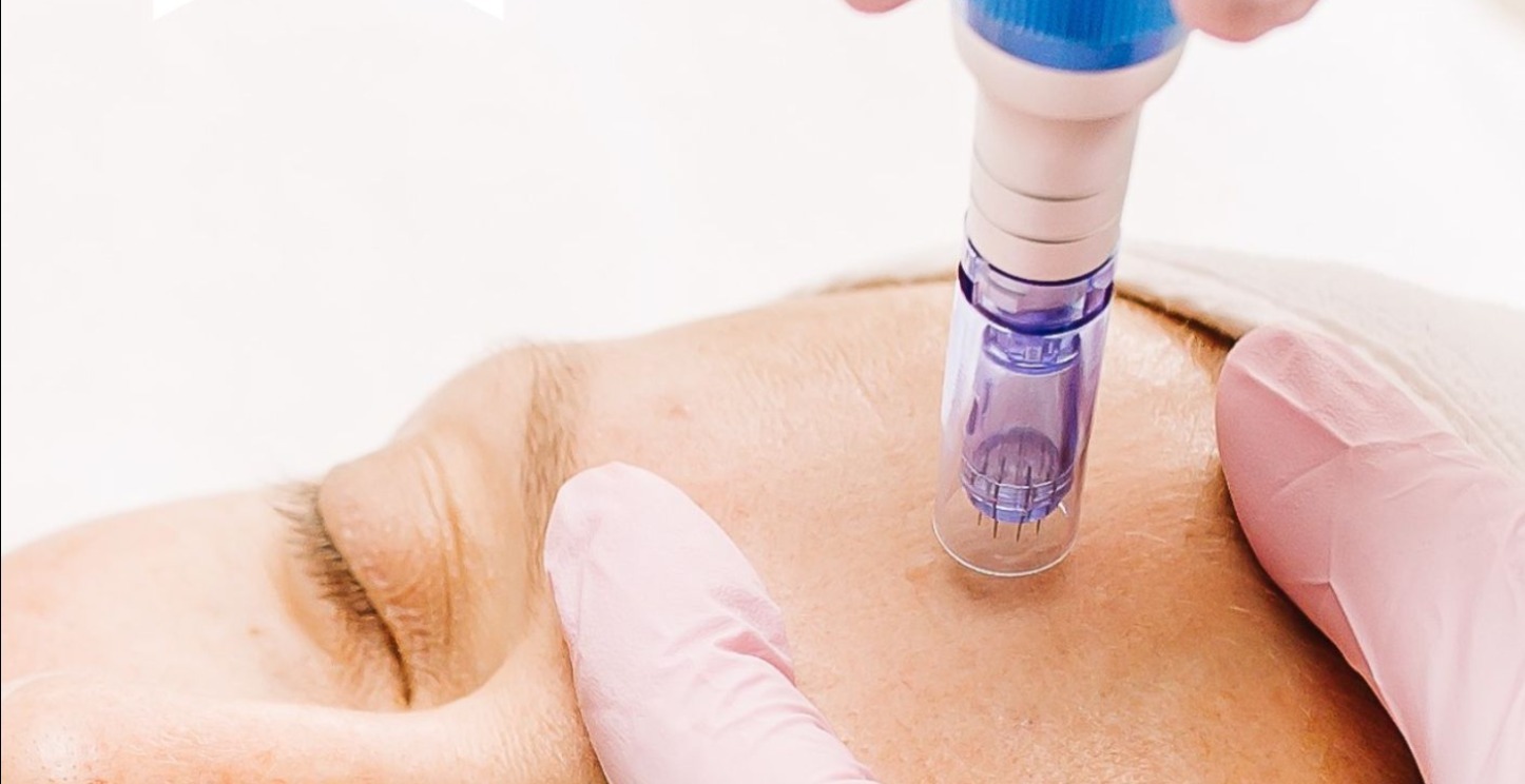 Micro Needling Masterclass