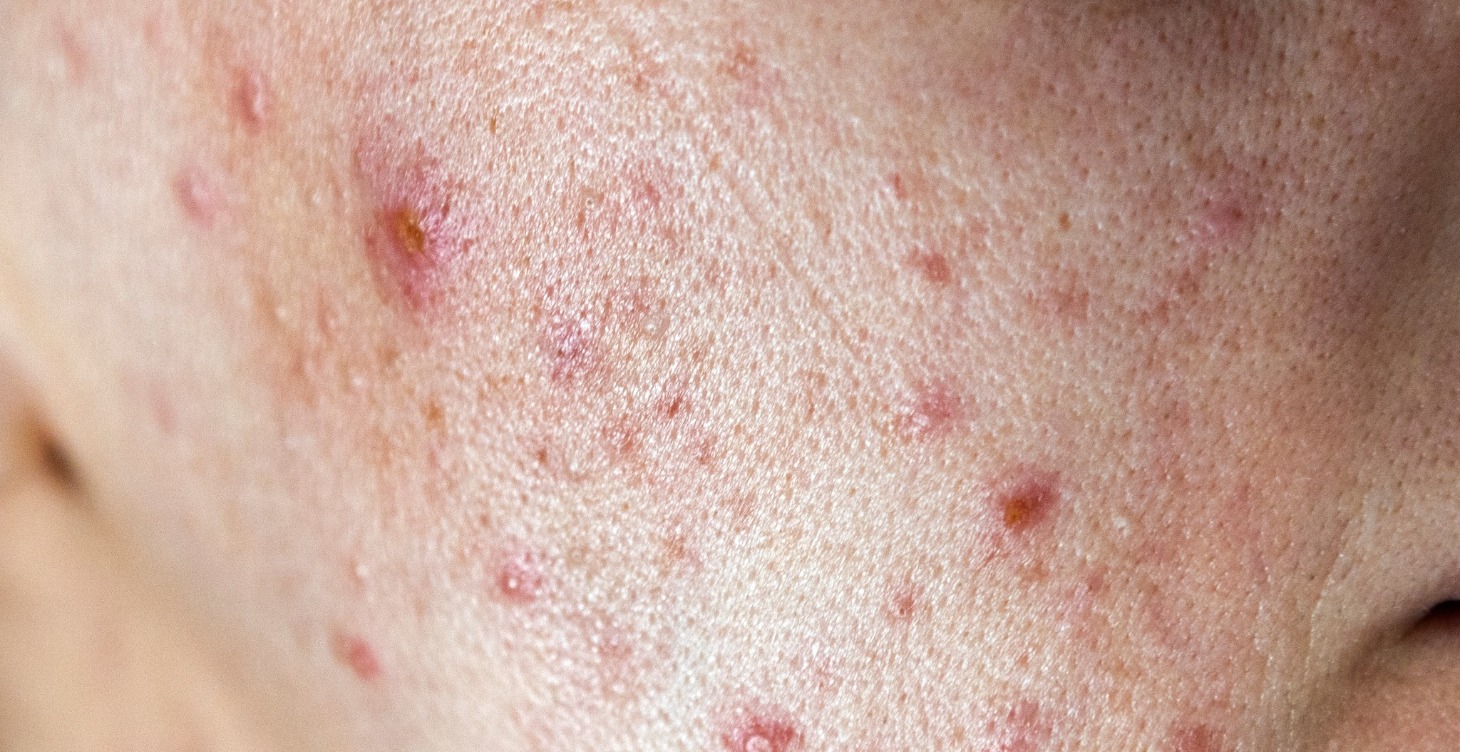 Practitioner’s Handbook - Acne