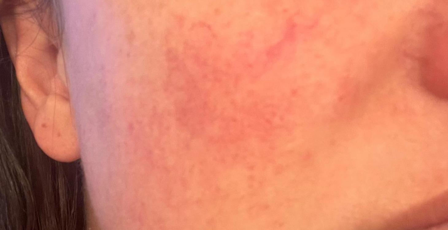 Practitioner’s Handbook - Rosacea