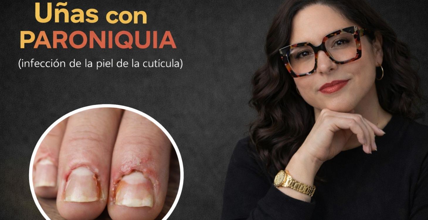 Paroniquia (Infección en la piel alrededor) #4