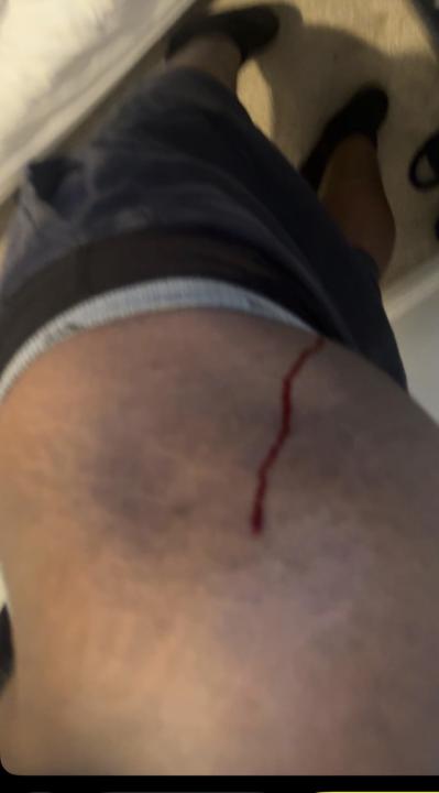 Does Tren ace make anyone else bleed like crazy 