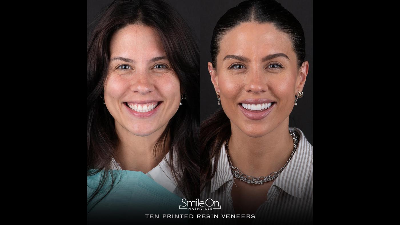 PERL Printed Veneers