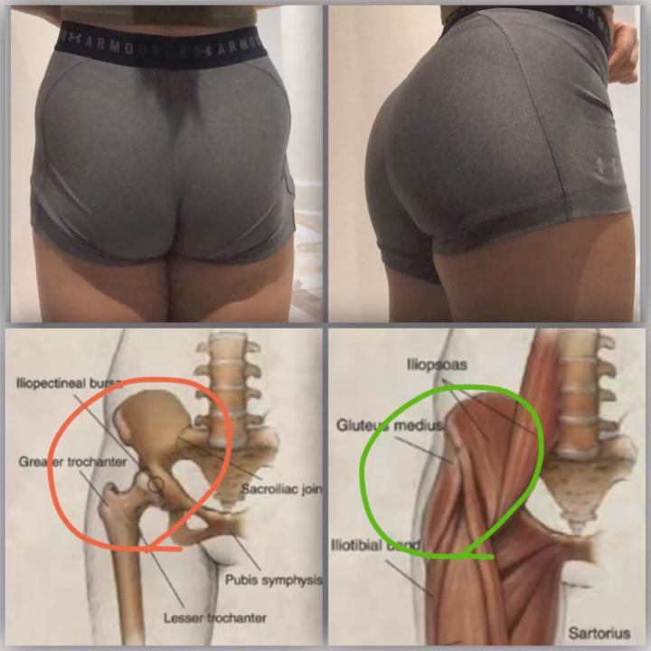 臀塌陷（Hip Dips）迷思？