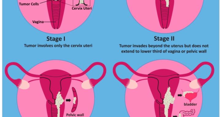 Understanding Cervical Cancer