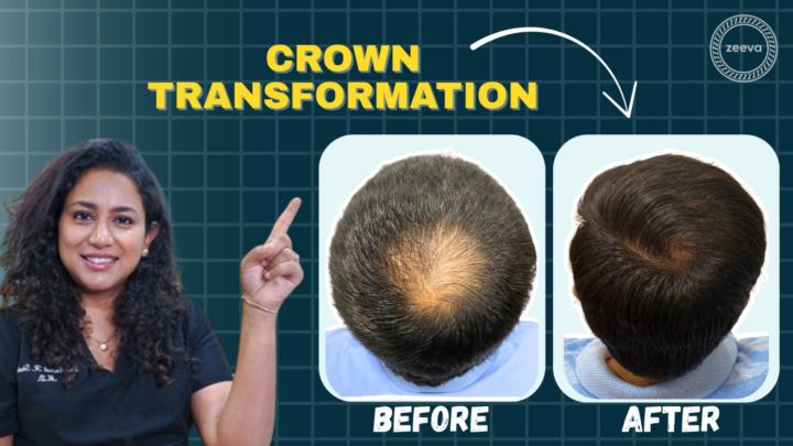 Affordable Hair Transplant Cost In India Ahmedabad With Best Results Zeeva Skin And Hair Clinic