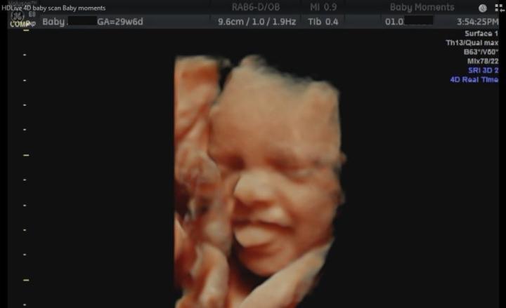 Ultrasound Scan