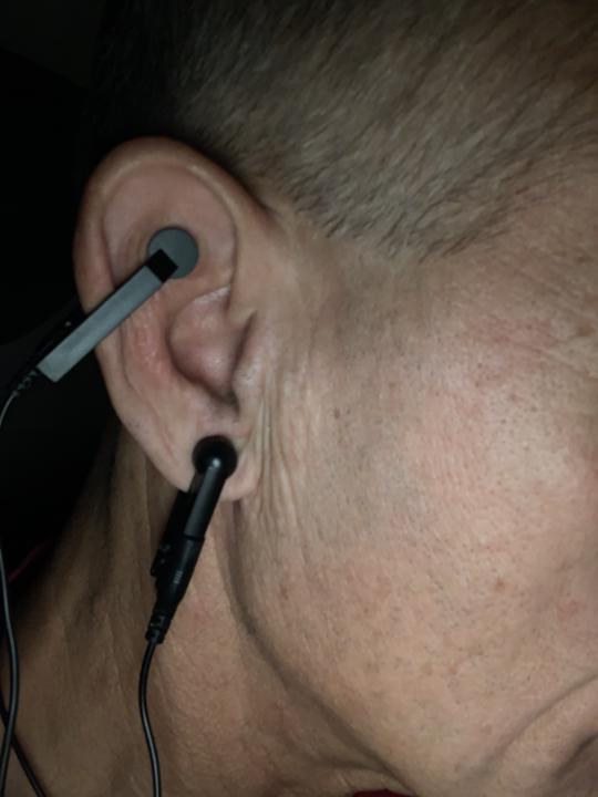 Einsatz des VNS bei Tinnitus