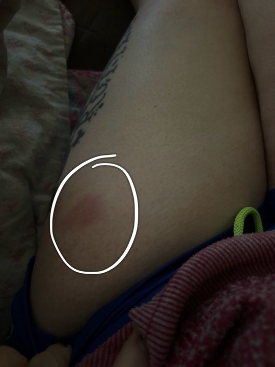 Injection Site