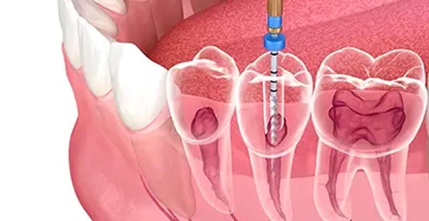 Tres dias Intensivo Endodoncia