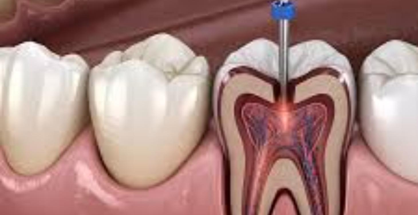 Intensivo Endodoncia