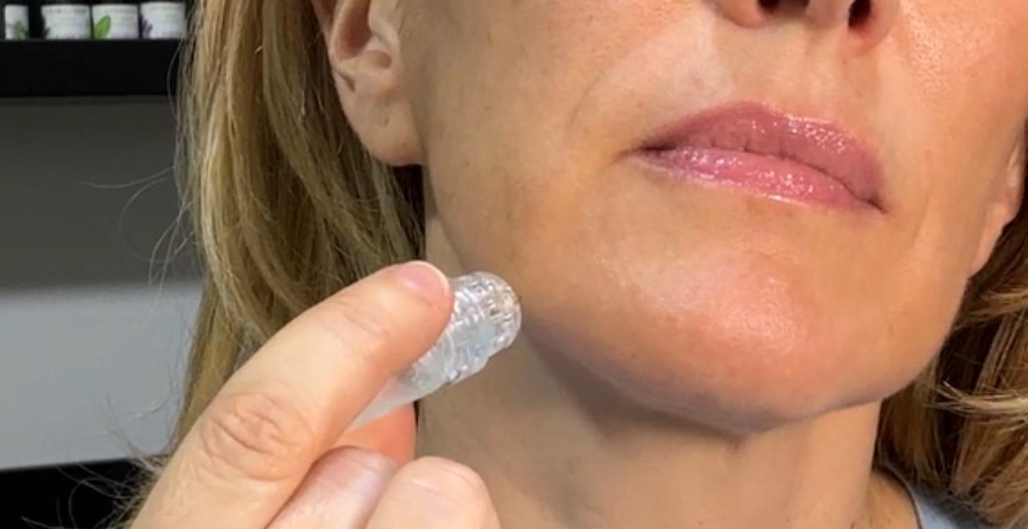 Como usar Hidraneedling Parte 2