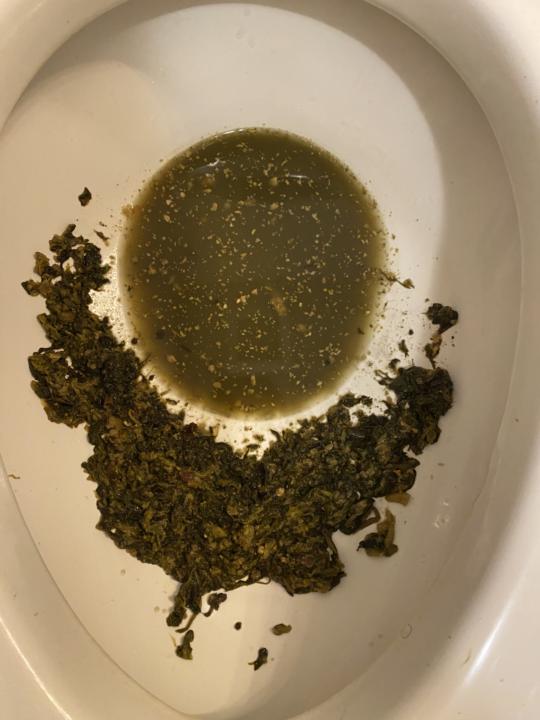 Morgellons fiber from covid( a week after kidney and lymphatic detox)