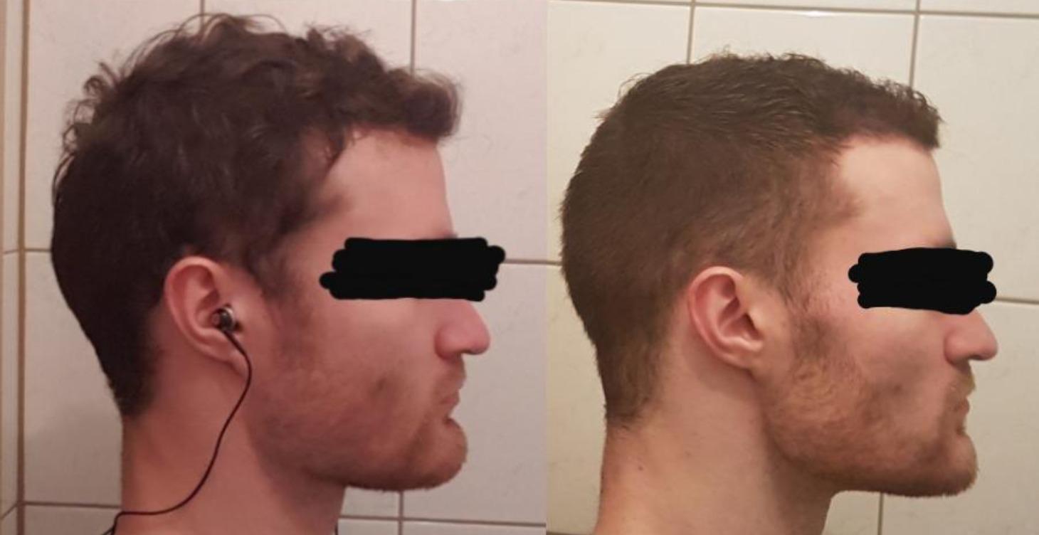 Thumbpulling (Not a jester JFL only theoretical)