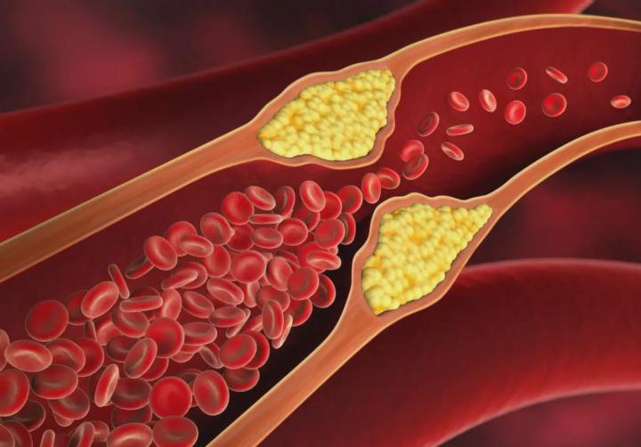 Rest-Cholesterin – der neue Bösewicht?