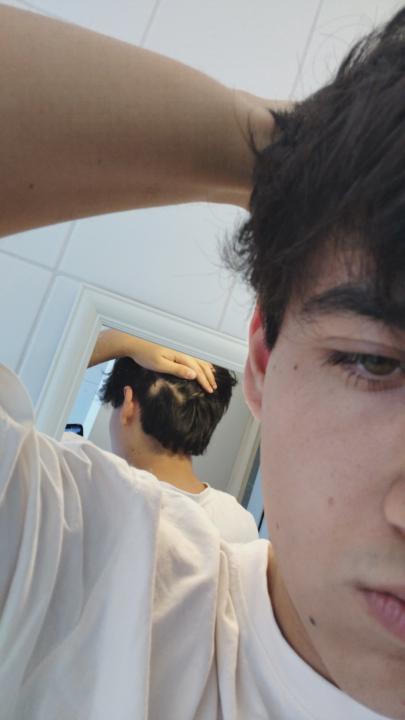 caidas del pelo en parches