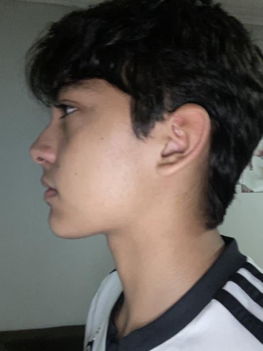 Hola, creo que tengo retraído el mentón el orbital y el maxilar podrían quitarme la duda? Y qué ortodoncia me podría ayudar? mi paladar mide 38 mm y en los dientes no tengo apiñamiento ni maloclusiones
