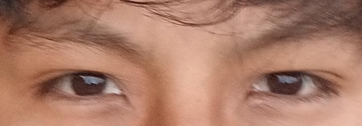 Eye area 