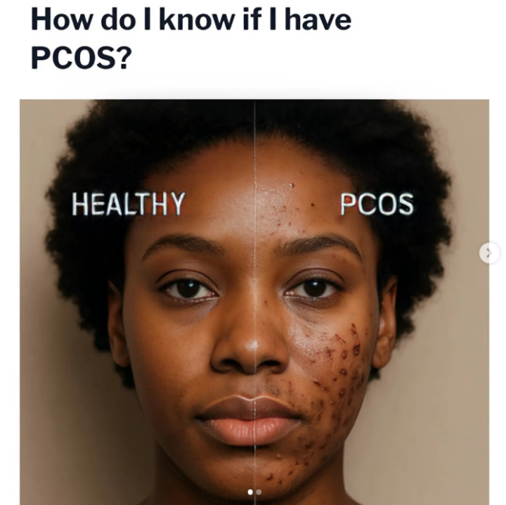 Cystic acne that just won’t go away? 😩