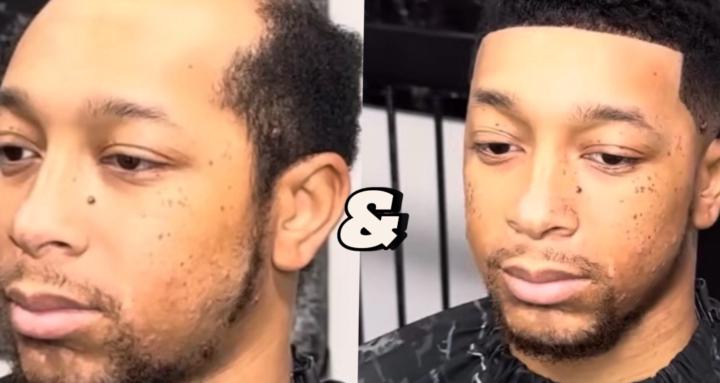 Men’s Hair Line Replacement