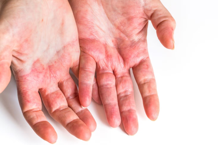 Dyshidrotic Eczema (Pompholyx) or Interdigital Dermatitis