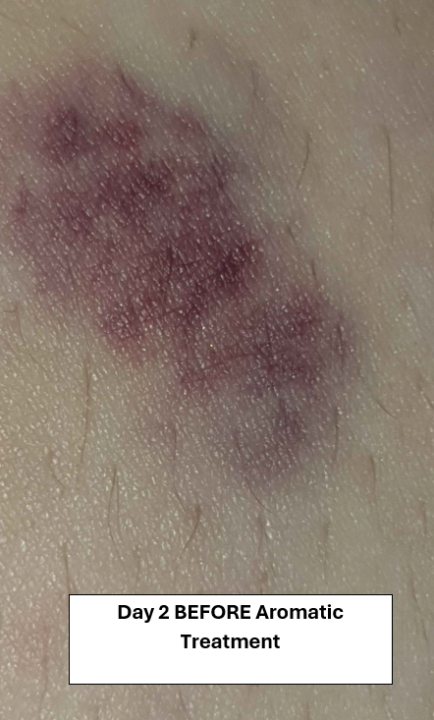 A Bruise Cream: Importance of Choosing Your Base