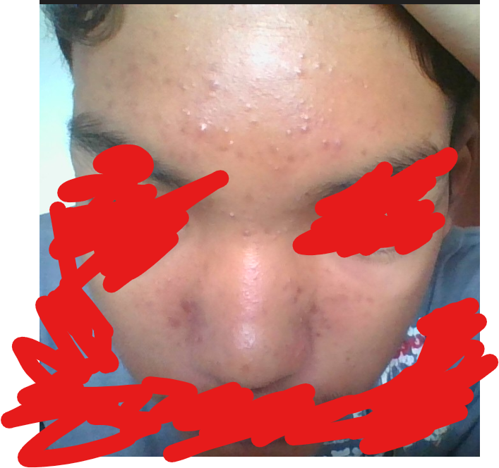 Struggling with acne