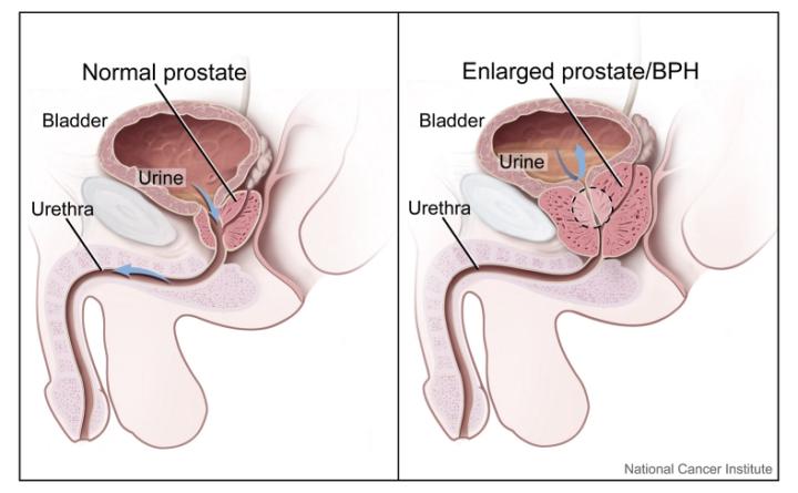 What is a Prostate Anyway?