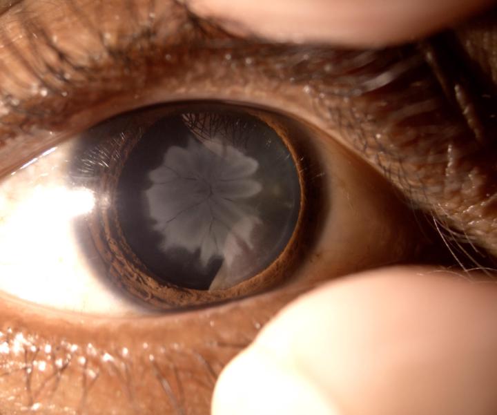 🌻 Traumatic Sunflower Cataract: From Blunt Injury to Excellent Outcome