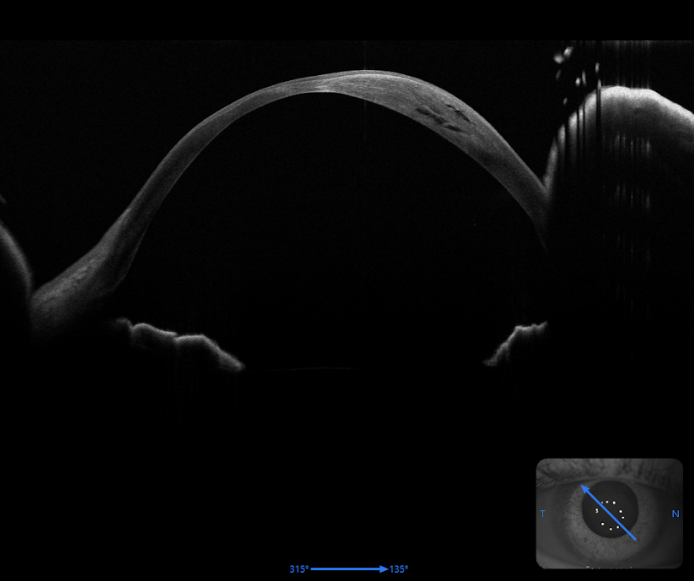 Keratoconus Complication Spotlight: Corneal Hydrops