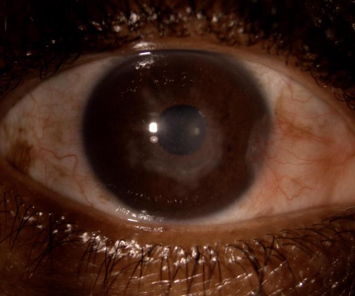 HSV Keratitis: Small Virus, Big Impact on Vision