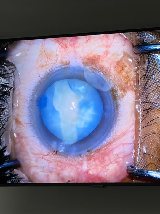 The Argentinian Flag Sign in Cataract Surgery 