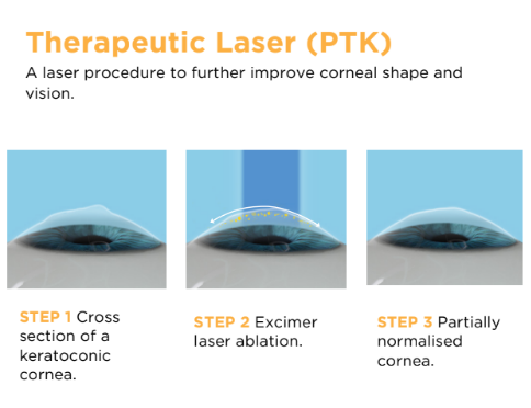 Therapeutic laser in keratoconus to improve quality of vision.
