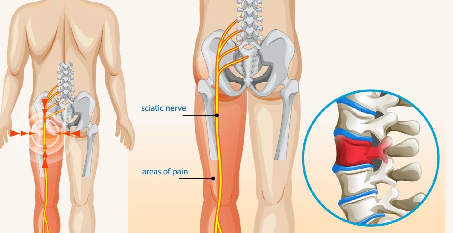 🌿Holistic & Metaphysical Sciatica Healing Program