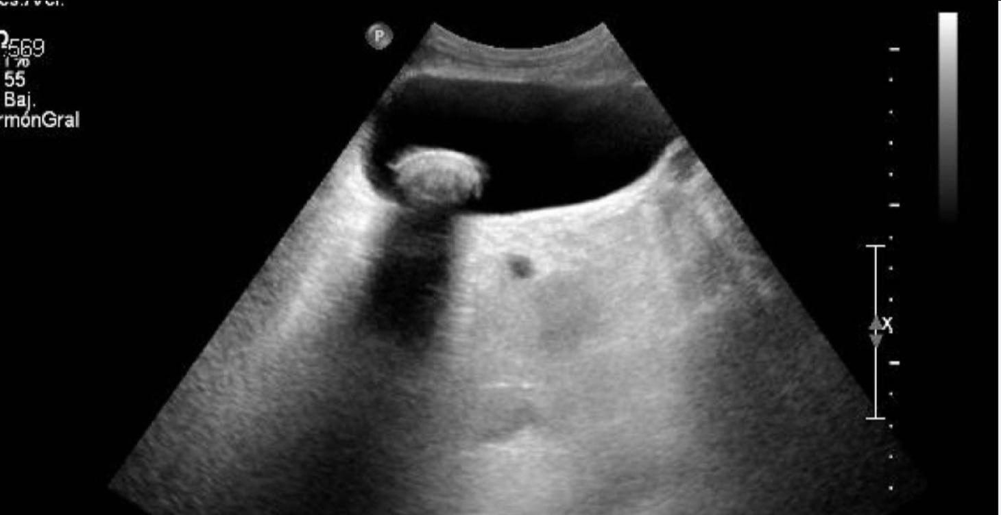 Curso Ecografía vesicular