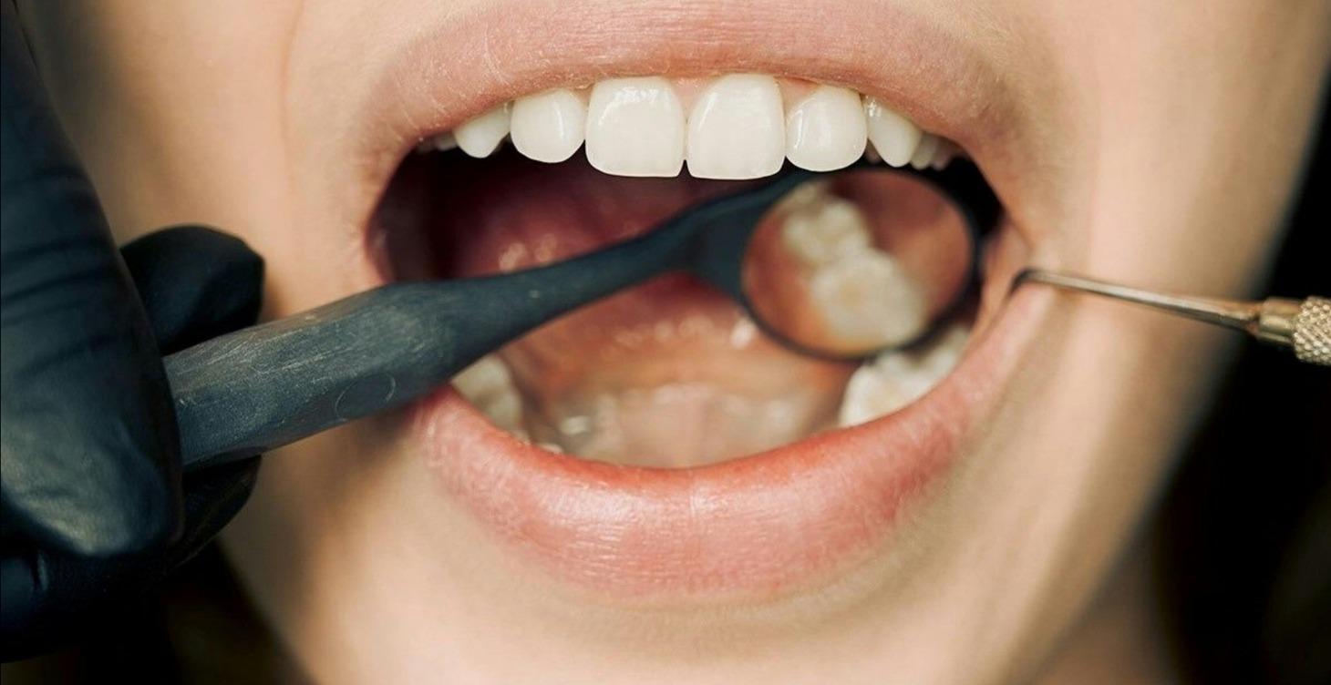 The oral microbiome