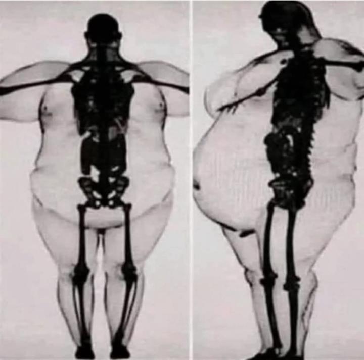 “Body Positivity” Shouldn’t Ignore the Medical Reality