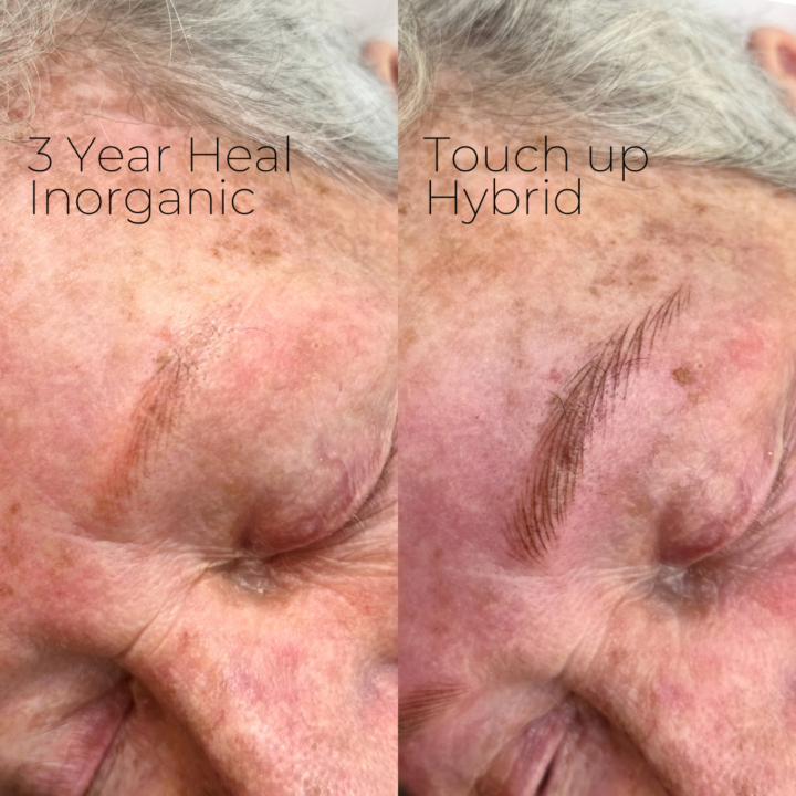 Healed result on very mature skin 