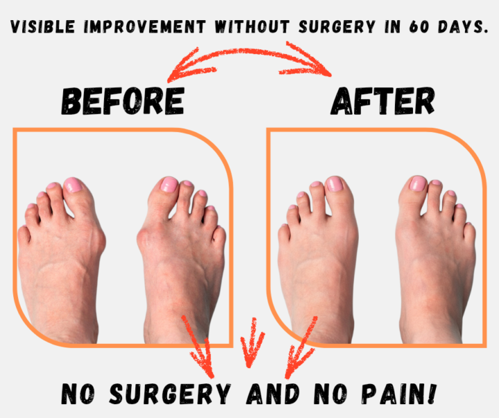 ARE YOU FACE TOEIC HALLUX VALGUS?