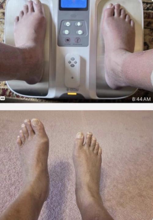 Swollen ankles