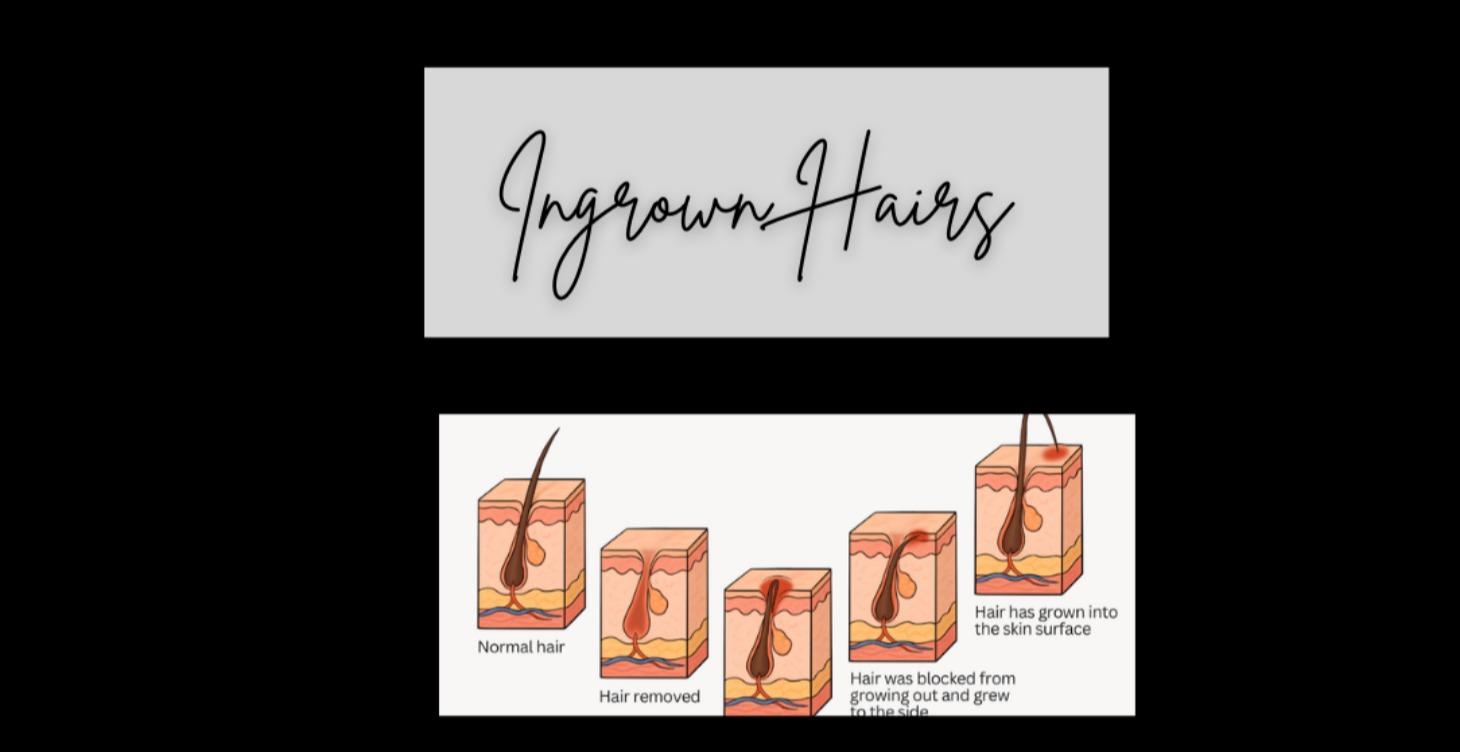 Ingrown Hairs