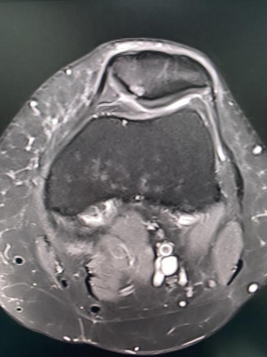 Chondromalacia patella ?