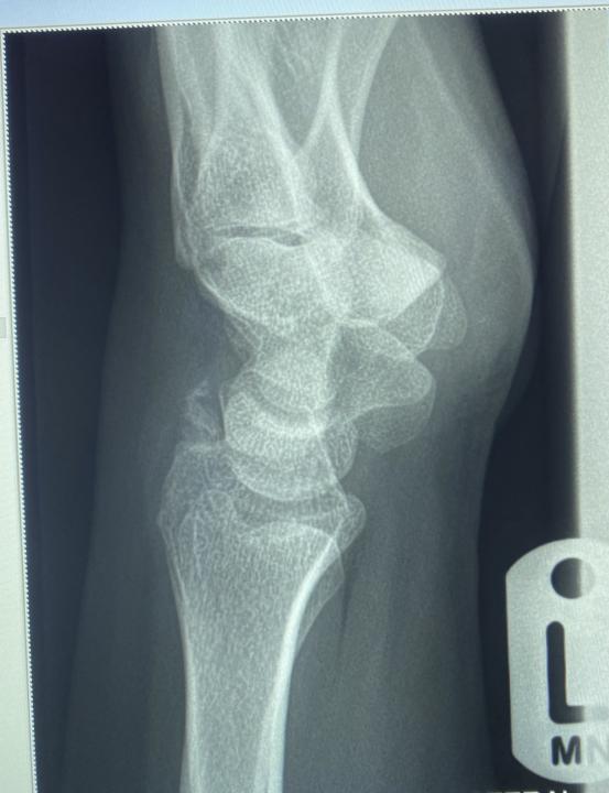 Fracture distal radius or accessory bone ?